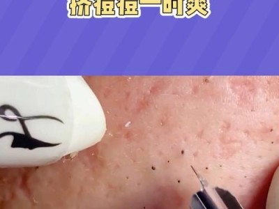 挤痘痘的后果和注意事项（以挤痘痘会怎样？如何正确挤痘痘？）